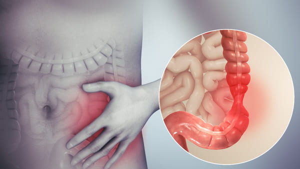 Viêm đại tràng co thắt: Nguyên nhân và cách phòng bệnh