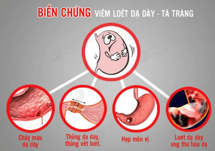 Khắc phục viêm loét dạ dày lâu năm nhờ tảo xoắn kết hợp ô tặc cốt