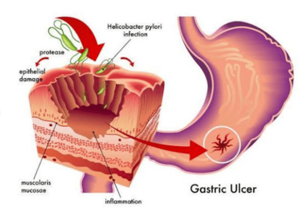 Nhiễm H.pylori (HP) là gì? H.pylori lây qua đường nào?