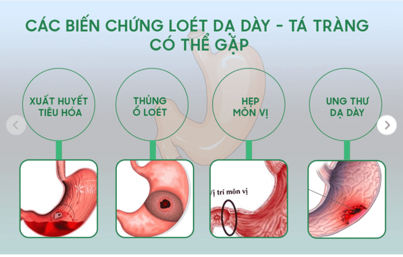 Thủng dạ dày là gì? Nguyên nhân của bệnh và nguyên tắc điều trị