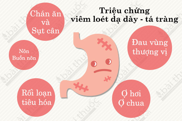 Trị dứt điểm viêm loét dạ dày, hành tá tràng