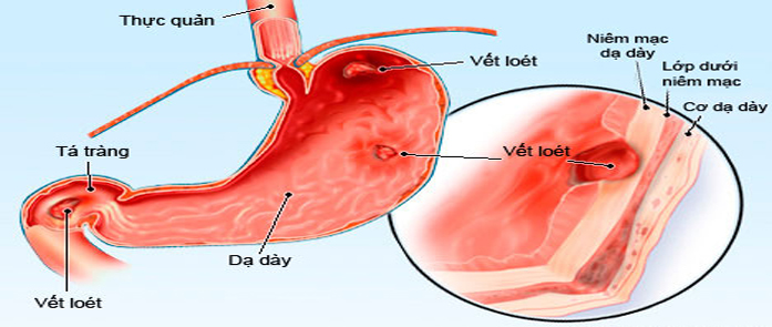 Trị dứt điểm viêm loét dạ dày, hành tá tràng