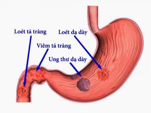 Trị dứt điểm viêm loét dạ dày, hành tá tràng