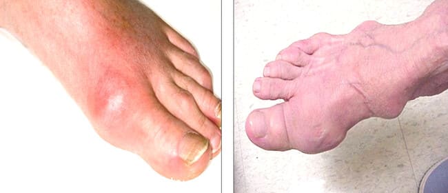 Chia sẻ một số điều cần biết về bệnh gút