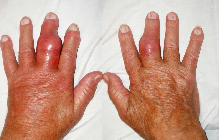 Nguyên nhân, triệu chứng, chẩn đoán và điều trị bệnh gout (gút)