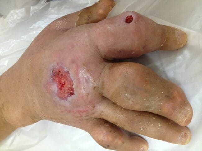 Thống kê những biến chứng nguy hiểm của bệnh gout (gút) thường gặp