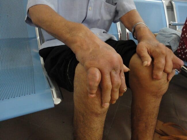Thống kê những biến chứng nguy hiểm của bệnh gout (gút) thường gặp