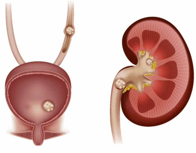 Thống kê những biến chứng nguy hiểm của bệnh gout (gút) thường gặp