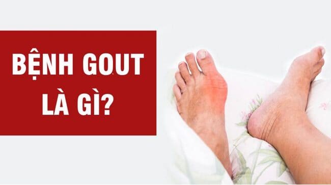 Cách phòng chống bệnh gout (gút)