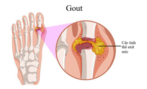 bien-chung-nguy-hiem-cua-benh-gout