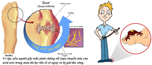 chi-so-nao-xac-dinh-benh-gout-gut