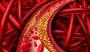 cholesterol-mau-cao-tang-nguy-co-mac-benh-tim