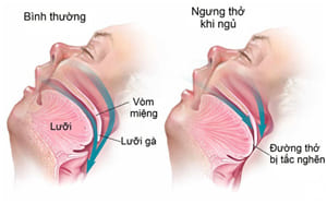 Đối phó với cơn đau đầu khi ngủ