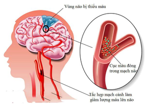 Đông y điều trị thiểu năng tuần hoàn não
