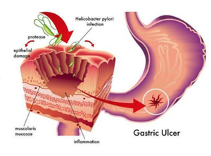 Nhiễm H.pylori (HP) là gì? H.pylori lây qua đường nào?