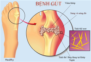 tang-acid-uric-trong-mau-co-phai-bi-gout