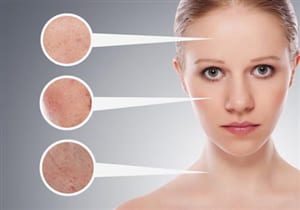 Ứng phó với chứng sạm da, rám má