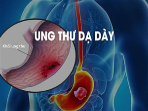 Ung thư dạ dày ngày càng gia tăng - Cách phòng ngừa